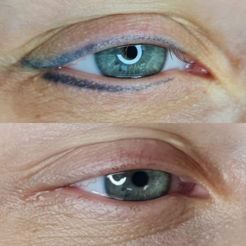 הסרת איפור קבוע (אייליינר) בלייזר – מחיר ומידע מפורט