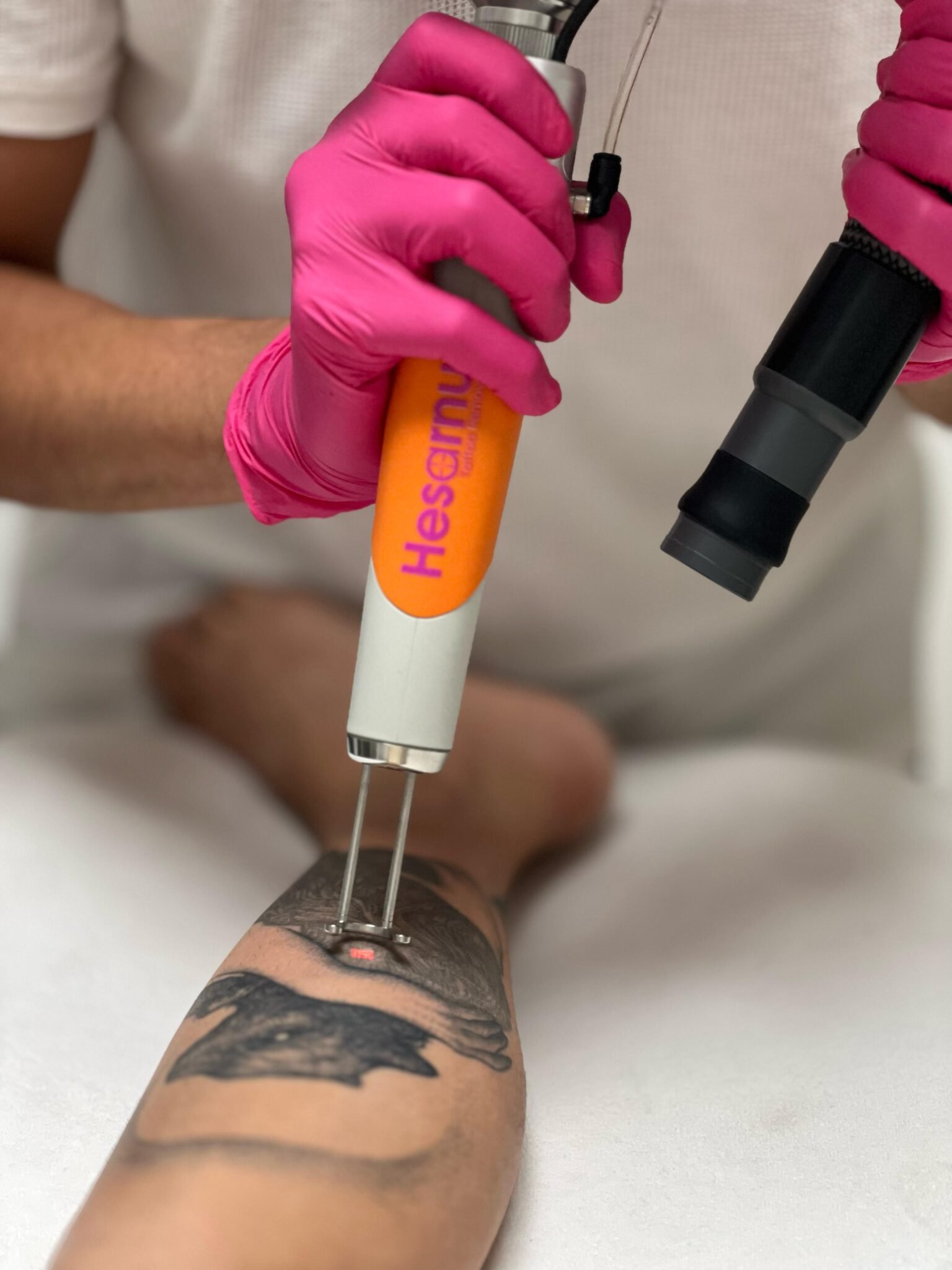 טיפול בשלפוחיות לאחר הסרת קעקוע בלייזר