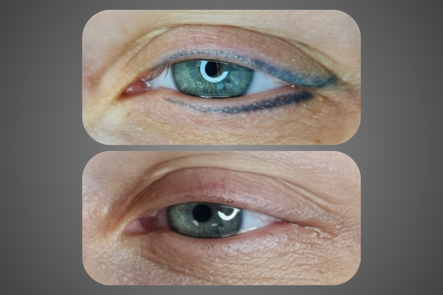 תמונות לפני ואחרי הסרת אייליינר