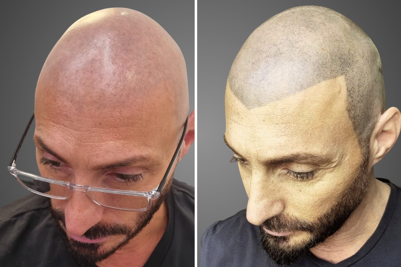 תמונות לפני ואחרי הסרת הדמיית שיער