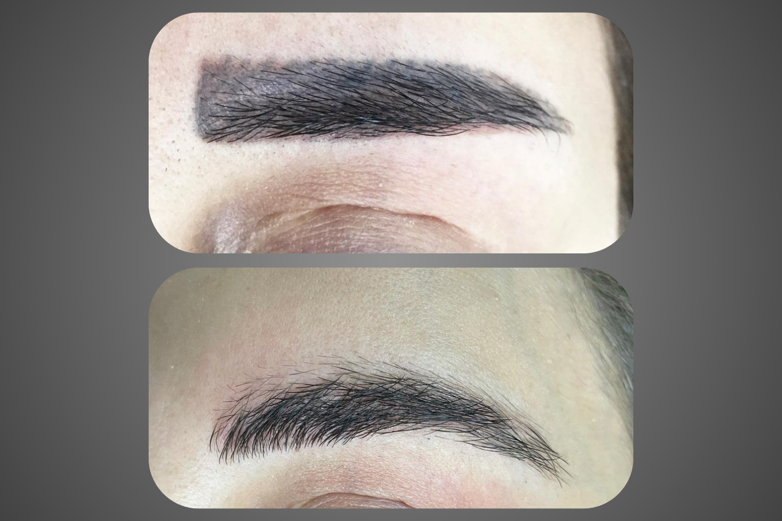 תמונות לפני ואחרי הסרת פיגמנט גבות