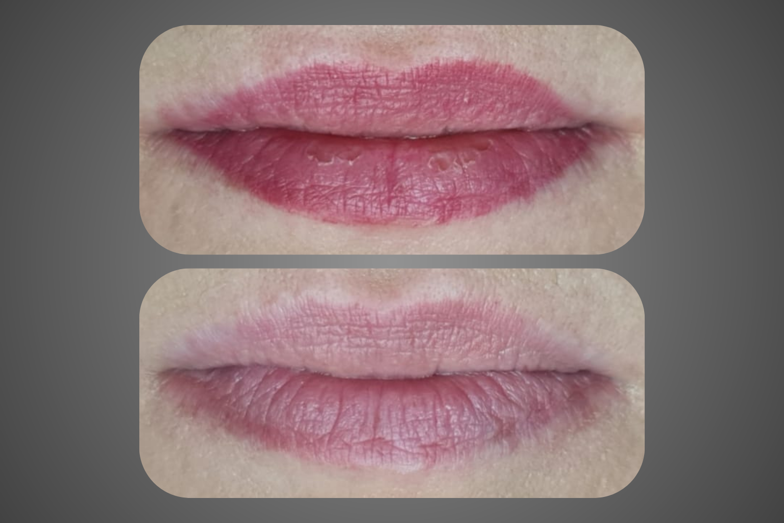 תמונות לפני ואחרי הסרת פיגמנט שפתיים