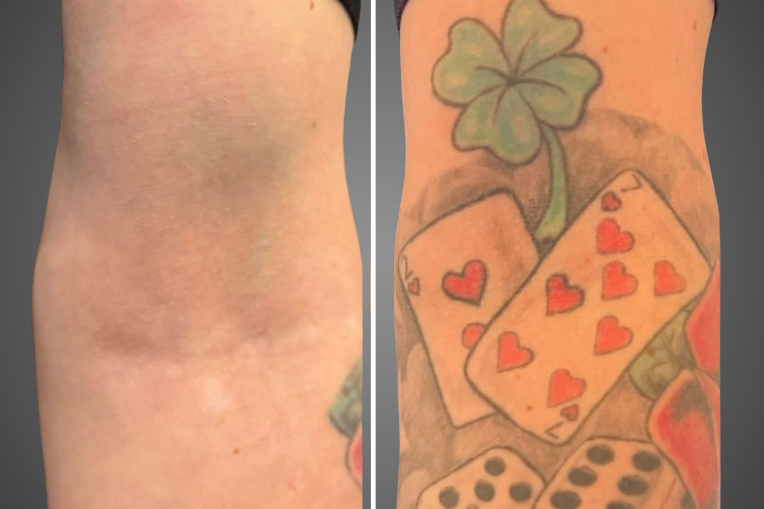 תמונות לפני ואחרי הסרת קעקוע צבעוני