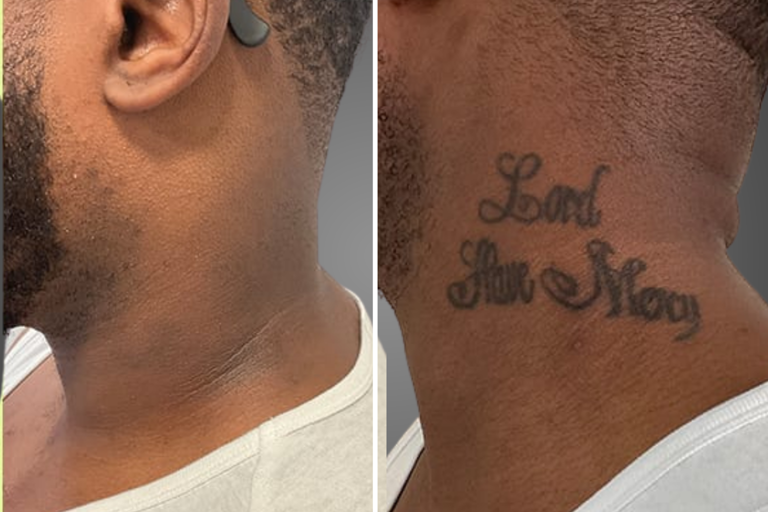 תמונות לפני ואחרי הסרת קעקוע שחור מעור כהה